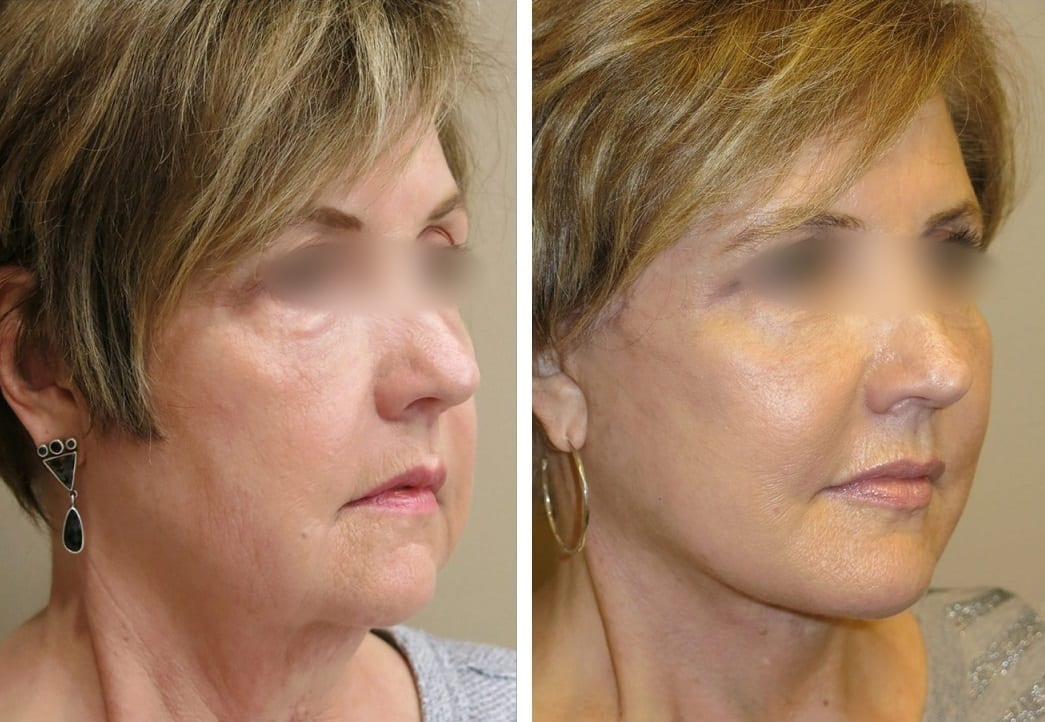 Lifting Facial y Cuello caso 6 — antes y después
